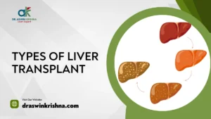 Types Of Liver Transplant