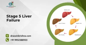 Stage 5 Liver Failure