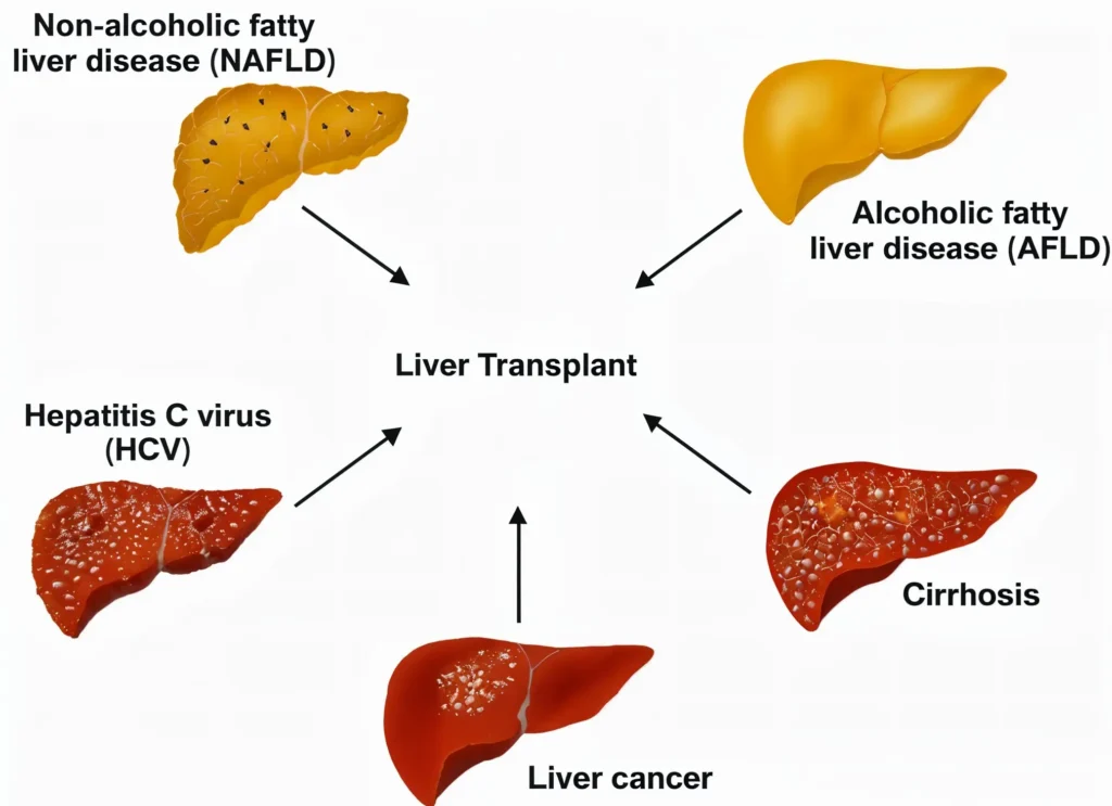 Hepatitis C And Liver Transplant