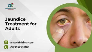 Jaundice Treatment for Adults