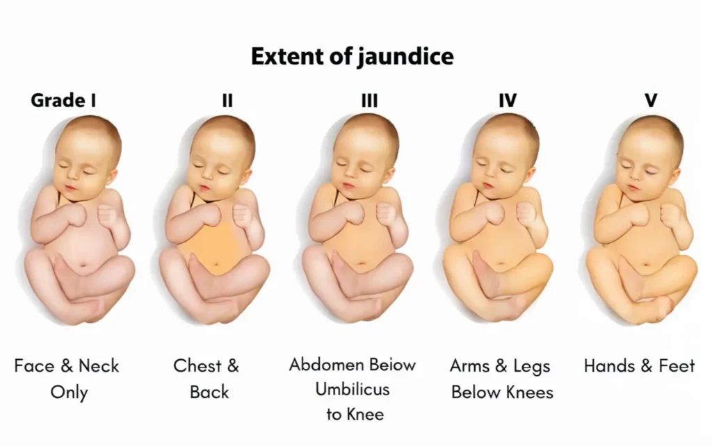 Treatment of Jaundice in Newborn
